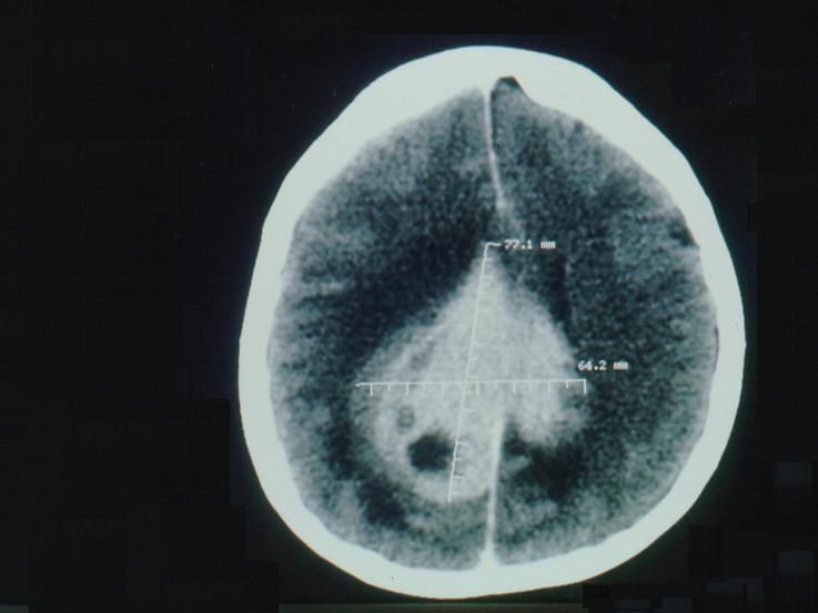 Neoplasia intracraniana Idade: 21-72 anos Duração: 20 dias a 3 anos Localização Tipo Tamanho Edema ou HIC N=13