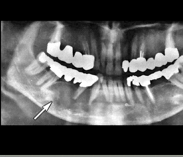 AMELOBLASTOMA