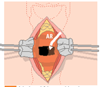 2.2. Cricotireoidostomia: A Cricotireoidostomia, ou coniotomia, consiste na abertura da membrana cricotireóidea, cricotraqueal ou tireo-hióidea comunicando-a com o meio externo.