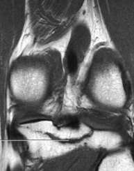 Ligamento cruzado posterior RM: Completas Podem