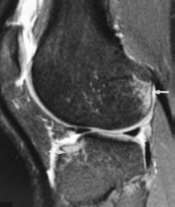 Ligamento cruzado posterior RM: Outras lesões associadas: Contusões ósseas: tíbia antero-lateral e côndilo femoral postero-lateral (deslocamento