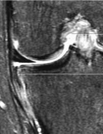 Ligamento cruzado posterior RM: Outras lesões associadas: Fractura de Segond reversa (reverse Segond fracture ) fractura avulsão da vertente