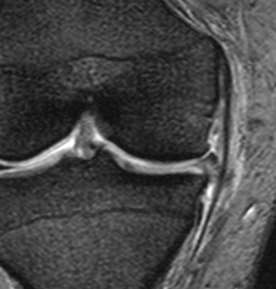 Ligamento colateral medial RM Grau I Distensão Hipersinal