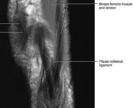Ligamento colateral lateral / Canto postero-lateral Ligamento fibulo-colateral (LCL) insere-se no epicôndilo femoral lateral Tendão do bícipite e