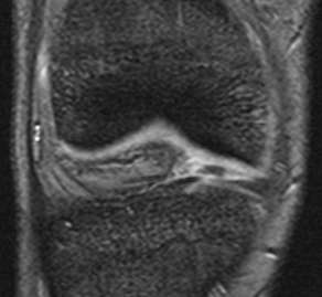 Rupturas longitudinais Quase sempre associadas a lesão significativa do joelho - +++ LCA +++ ponta