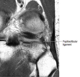 Ligamento colateral lateral / Canto postero-lateral Outras estruturas importantes (identificáveis na maioria): Ligamento poplíteo-fibular Um