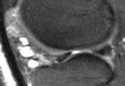 Quistos meniscais RM Quistos parameniscais franco hipersinal em T2, imediatamente junto ao menisco ou com trajecto líquido