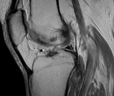 Rupturas meniscais Pitfalls Ligamentos