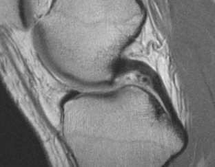 Rupturas meniscais Pitfalls Ligamentos