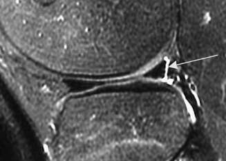 Menisco Discóide Variante de Wrisberg (tipo III) Sinais em RM: Ausência dos fascículos que ligam ponta posterior do menisco lateral à