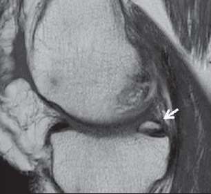 Ossículo Meniscal Anomalia do desenvolvimento ou pós-traumática (ossificação Heterotópica) Focos de ossificação pequenos (7-10mm), tipicamente na ponta posterior do menisco