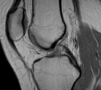 Ligamento cruzado anterior Sinais de Ruptura Ângulo do cruzado posterior Linha tangente à porção distal do LCP Linha