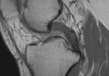 Ligamento cruzado posterior RM: Espessamento difuso do