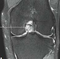 Ligamento cruzado posterior RM: Parciais estrutura fibrilhar heterogénea