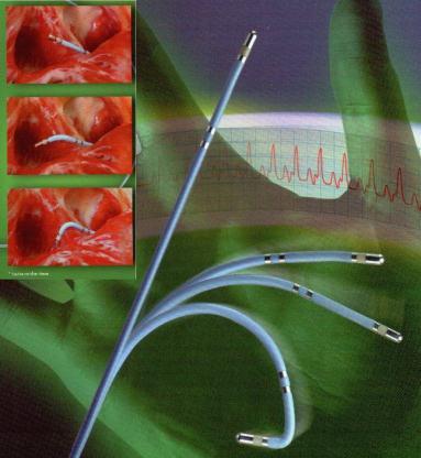 Diagnóstico... Estudo Eletrofisiológico Exame invasivo minucioso (utiliza vários eletrodos dentro do coração). Feito por especialista: eletrofisiologista.