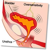 Principais tipos de incontinência urinária Tipo Incontinência por imperiosidade (hiperactividade do detrusor) Descrição Perda involuntária de