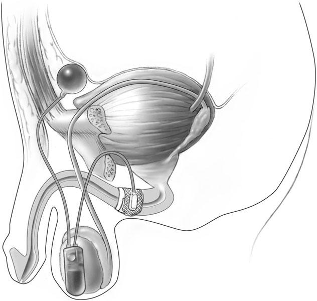 Incontinência urinária no homem Diferente anatomia da continência Iatrogenia Urgincontinência No contexto de LUTS (Lower