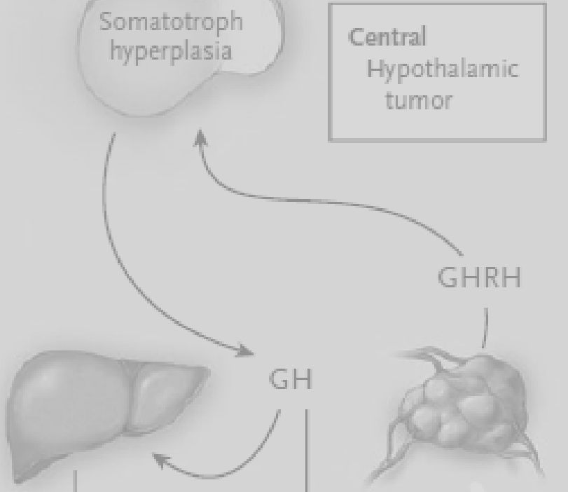 Patogênese Adenoma hipofisário (>90-99%) Excesso primário de GH > 70% são macroadenomas ao diagnósticos Tumor neuroendócrino produtor de GHRH
