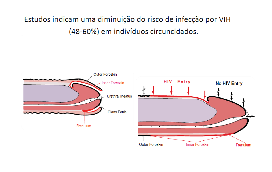 O HIV presente nas secreções sexuais precisa de contato íntimo e