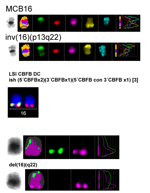 56 A B CBFB normal Cromossomo 16 normal C Figura 18 Técnica de MCB e FISH para o cromossomo 16, mostrando anomalia citogenética inv(16)(p13;q22)del(16)(q22).