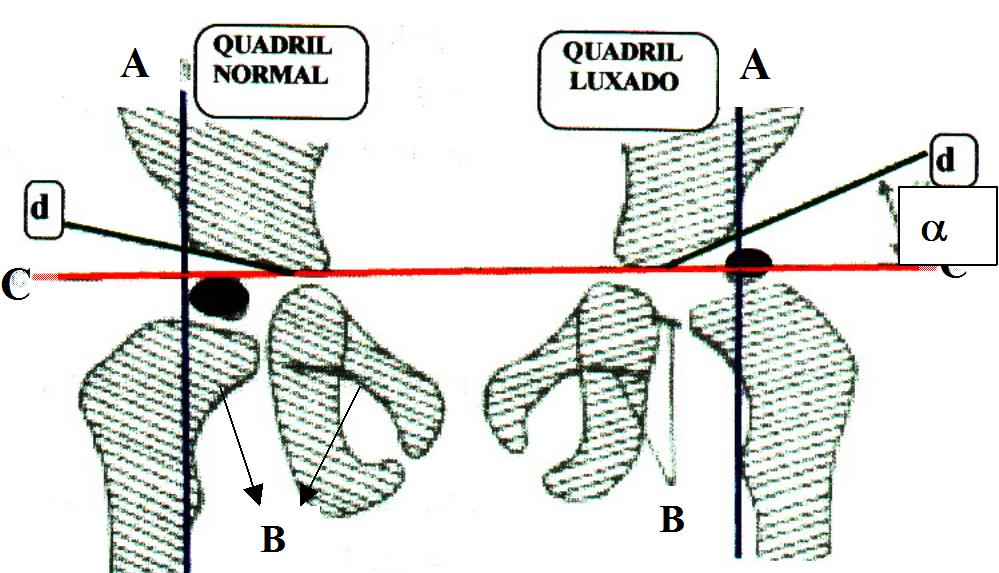a: linha vertical de PERKINS b: arco de SHENTON c: linha horizontal de HILGENRAINER d: ângulo ACETABULAR TRIADE DE PUTTI A tríade radiográfica do "Dr.
