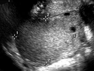 Lesões Ováricas Endometriomas Ovário local mais comum para implantação extra-uterina de tecido endometrial Transformação maligna para carcinoma endometrióide ou de células claras descrito