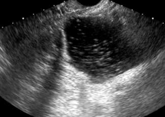 Lesões Ováricas Teratoma Quístico Maduro (Dermóide) Neoplasia benigna ovárica comum ACHADOS ECOGRÁFICOS Cabelo: área hiperecogénica com