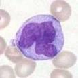 MONONUCLEARES 1-1-Plasmócito, 2-Linfócito e 3-Monócito: Esclerose múltipla 2- Meningite viral Meningite