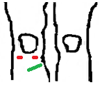 e Cuidads de Saúde Unipessal Lda Fisiterapia C Ortpedia Traumatlgia A B Legenda: A - duas cicatrizes de 1 cm (jelh dt) B - uma cicatriz de 6 cm (jelh dt) C - Edema na regiã supra-patelar (jelh dt)