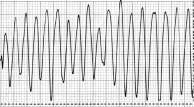 O flutter ventricular quase invariavelmente evolui para a fibrilação ventricular, necessitando de uma desfibrilação e ressuscitação cardiopulmonar.