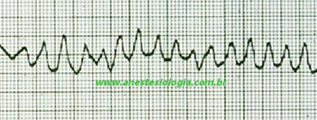 B.3.2) Flutter: Taquicardia cuja freqüência cardíaca encontra-se entre 200-300 bpm. Pode ser: B.3.2.1) Flutter Atrial Se origina em um foco atrial ectópico, com as ondas P apresentam-se em sucessão rápida, contínuas e idênticas (Figura 7).