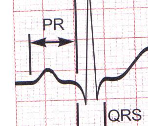 INTERVALO PR - Medida do início da onda P até o início do complexo QRS.