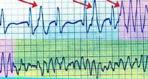 b)taquicardias ventriculares: Taquicardia ventricular: caracteriza-se por três ou mais extrassístoles seqüenciais, numa freqüência de 120 a 250 bpm.