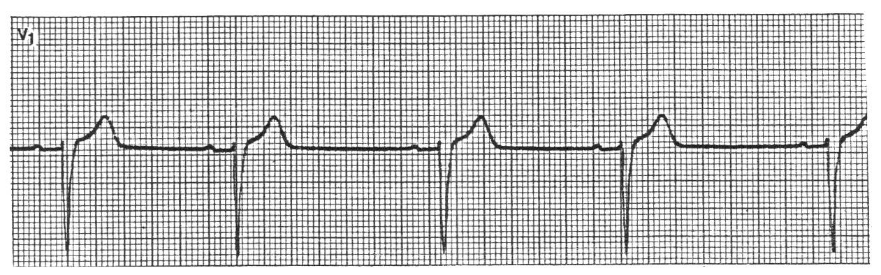 Ritmo sinusal: Corresponde ao ritmo normal do coração, com freqüência entre 60 e 100 bpm.