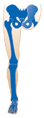 Amputação através do joelho (desarticulação do joelho). Amputação acima do joelho (transfemoral).