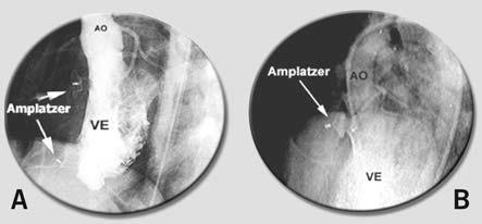 A) Ventriculografia esquerda, mostrando duas CIV fechadas com próteses de Amplatzer para CIV muscular B)