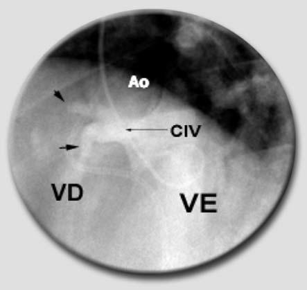 Ventriculografia seletiva mostrando CIV complexa com