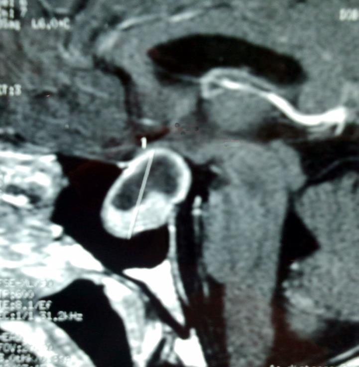 CASO CLÍNICO AM, sexo masculino, 31 anos, casado 1ª Consulta: agosto de 2006 História Médica: Cefaléia frontal há 2