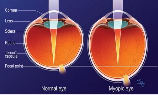 But in high myopia, weakness in the sclera causes ongoing growth and lengthening of the eyeball throughout life and can lead to vision-threatening complications like retinal detachment and macular