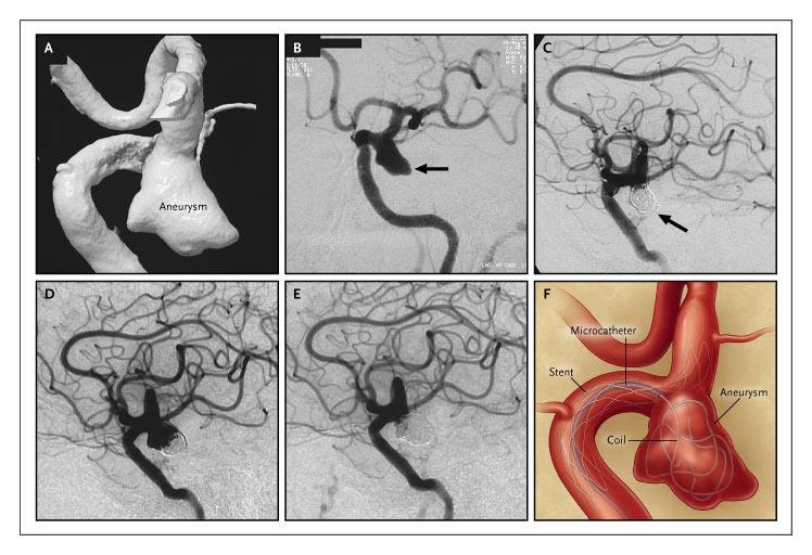 Stent