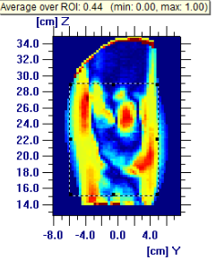 47 - Histograma da análise gama no plano sagital -0,55 cm, com critério de 3%, 3mm As Figuras 5.43 e 5.