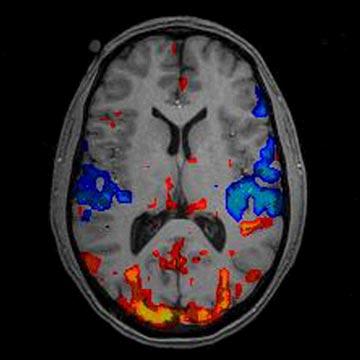 RESSONÂNCIA MAGNÉTICA FUNCIONAL (fmr) Analisa o fluxo sanguíneo no cérebro para detectar as áreas de