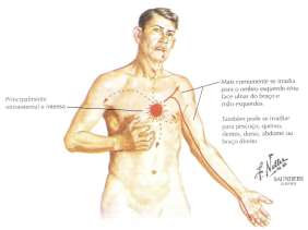 Tipos de Dor Tipos de Dor Resumo Como Diferenciar - AI X IAMSEST Angina Estável Angina Instável IAM Enzimas Cardíacas Desencadeamento Alívio