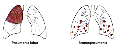 PNEUMONIA ADQUIRIDA NA Diagnóstico Radiológico LOBAR