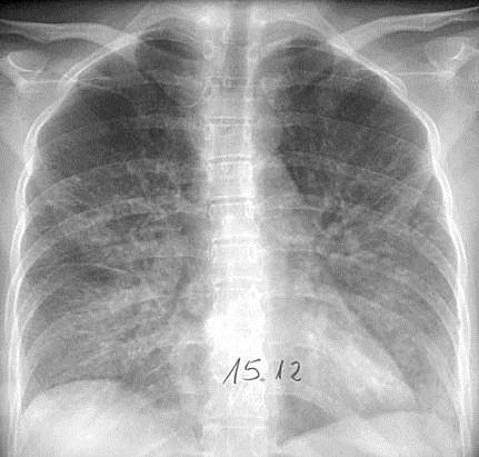 PNEUMONIA INTERSTICIAL Pneumonia Adquirida na Comunidade Caso clínico 09 PNEUMONIA NA INFÂNCIA E ADOLESCÊNCIA Padrões radiológicos principais nas pneumonias Padrão intersticial: espessamento