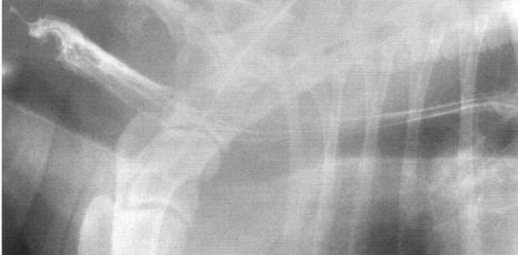 INTERPRETAÇÃO RADIOGRÁFICA O esôfago normal está colapsado exceto durante a deglutição e não é observado em radiografia simples Possui densidade similar as estruturas adjacentes Trânsito