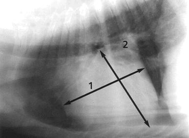 Aumento ventricular esquerdo