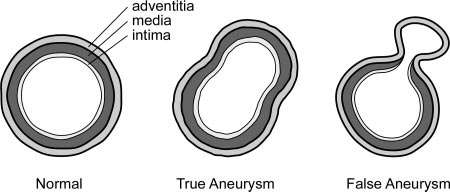 Aneurisma da aorta Os aneurismas verdadeiros são os mais comuns na aorta.