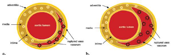 Hematoma intramural Resulta da rutura dos vasa vasorum, com consequente