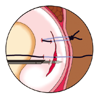 Lesão meniscal Tratamento cirúrgico